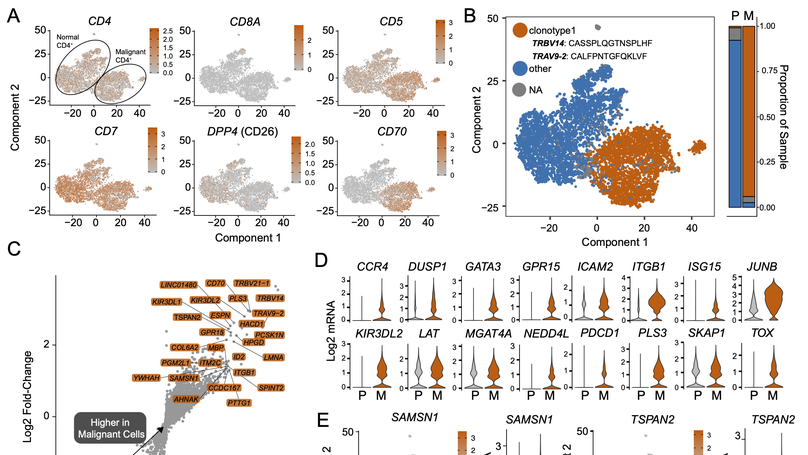 Single-Cell Profiling of Cutaneous T-Cell Lymphoma Reveals Underlying Heterogeneity Associated with Disease Progression