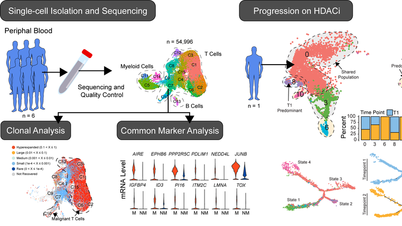 Single-cell analysis of Sézary syndrome reveals novel markers and shifting gene profiles associated with treatment